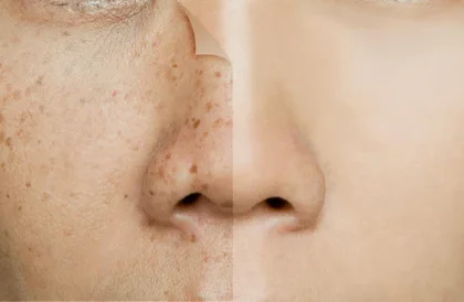 Remove Dark Spots on Face Fast Naturally: Quick Tips