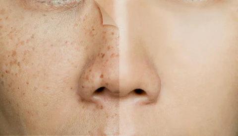 Remove Dark Spots on Face Fast Naturally: Quick Tips