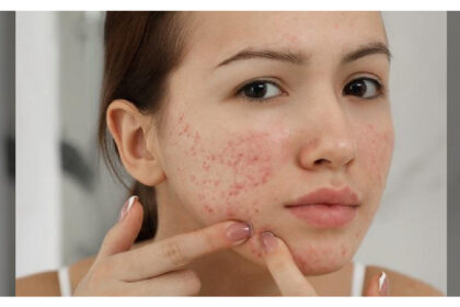 Wellhealthorganic Home Remedies to Remove Pimples: Gharelu Nuskhe